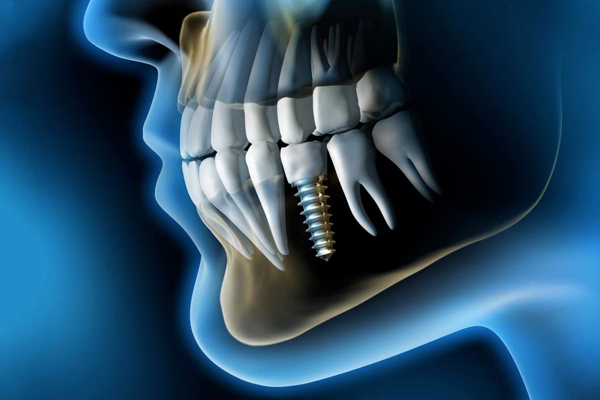 Implantologia dentaria Dott. Ramella Milano